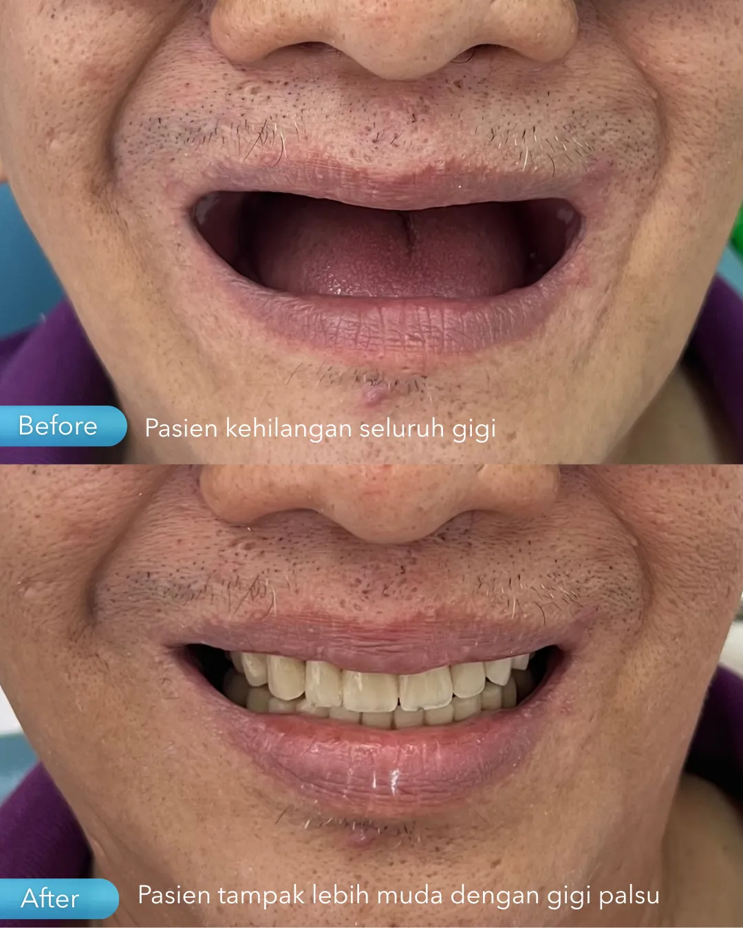 Gigi palsu result